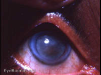 mature corticonuclear cataract with a cataracta nigra component