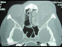medial wall and orbital floor blowout fractures, left