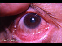 meibomian gland retention cyst with pemphigoid