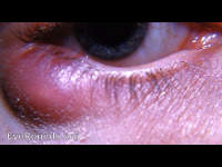 subsiding acute meibomianitis (meibomitis) going into the chalazion stage