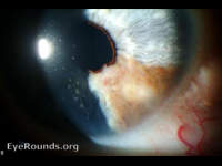iris melanoma