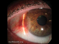 Conjunctival melanoma