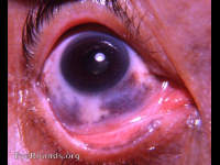 melanosis oculi wih pigmentation of tarsal conjunctiva near lid margin