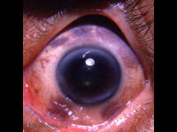 melanosis oculi
