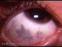melanosis oculi