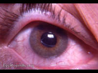 Anterior vitreous membrane following uncomplicated intracapsular cataract extraction with peripheral iridectomy