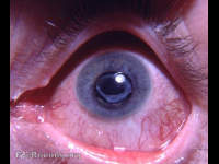 membranous cataract - remnant of congenital cataract through self-absorption