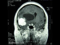 meningioma - intracranial