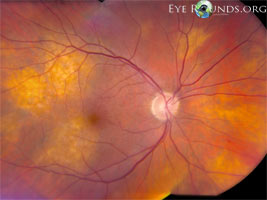 Choroidal tumors