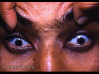 microcornea