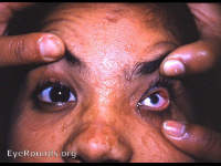 Micophthalmos