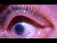 congenital microphthalmos