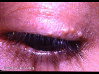 milia of skin of upper lid