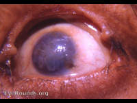 absence of upper lid