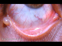 retention cyst of a gland of Moll