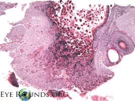 Molluscum contagiousum