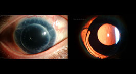 Morcher intraocular lens and penetrating keratoplasty (PKP) for traumatic aniridia