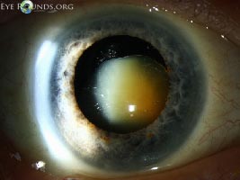 Morgagnian cataract with absent cortex