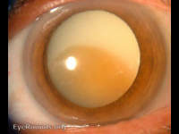 Morgagnian cataract