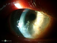 mycobacterial keratitis