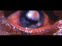 mycotic abscess of cornea with hypopyon