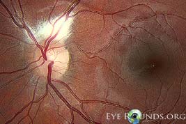 Myelinated Nerve Fiber Layers