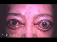 thyrotropic exophthalmos: Naffziger operation