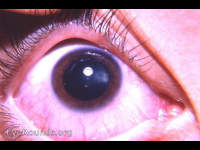 nanophthalmos with cataract