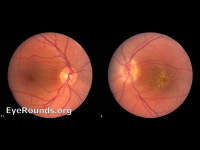 neuroretinitis