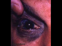 Caucasian with nevus of Ota