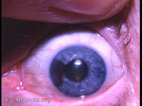 heavily pigmented iris lesion (differential diagnosis of)