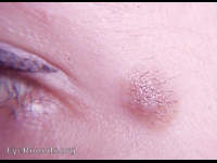 dermal nevus with hair