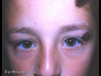 pigmented nevus