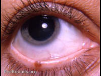 pigmented nevus of lid margin