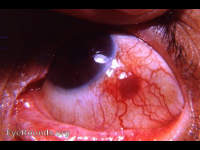Nodular Episcleritis