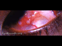 ophthalmia nodosa