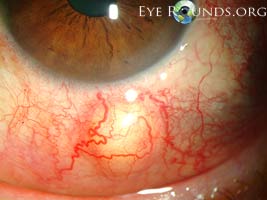 Nodular anterior scleritis