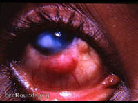 nodular scleritis with keratitis