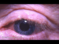 notching of upper lid margin with trichiasis