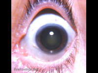 nuclear cataract - incipient stage