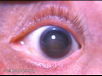 Nuclear cataract: a discussion
