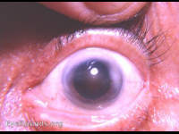 Nuclear sclerosis vs nuclear cataract