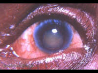 Shrunken Morgagnian cataract has slipped into the anterior chamber