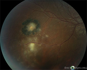 Ocular toxoplasmosis