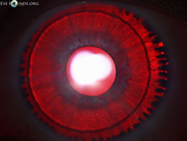 Oculocutaneous albinism