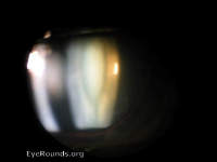 oil droplet cataract