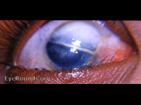 opaque cornea as a result of a perforating, linear laceration due to broken glass