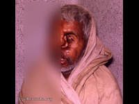 healed destructive ophthalmomyiasis externa