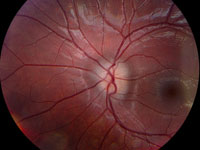 anomalous optic disc