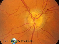 Optic Nerve Drusen